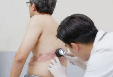 대상포진 초기증상 치료방법 예방법 총정리