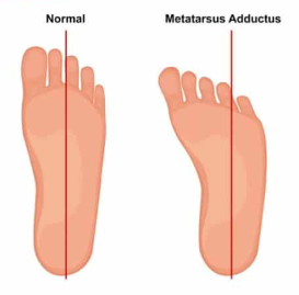 forefoot adduction