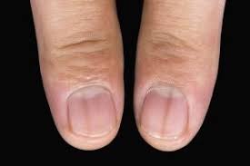 손톱에 세로 줄무늬가 생기는 이유