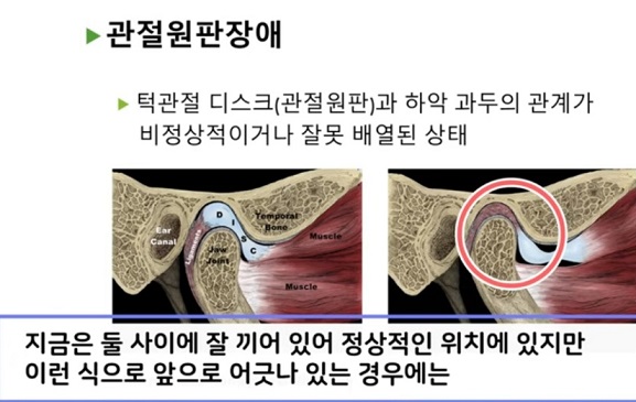 EBS명의-턱관절-고홍섭-교수