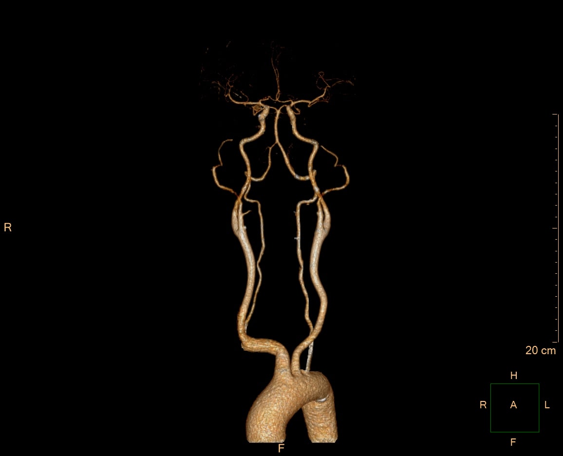 CT 혈관검사