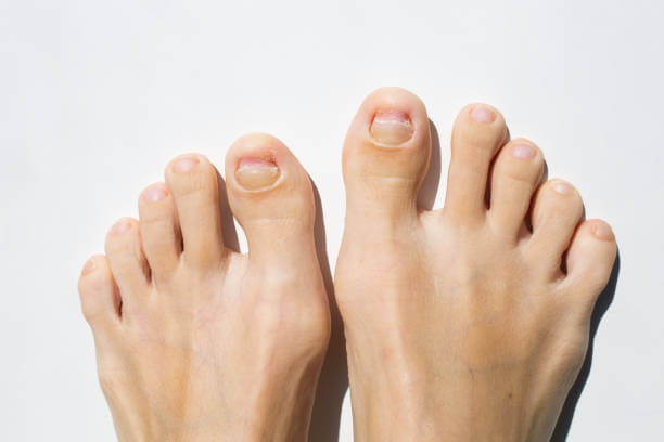 새끼발톱 갈라짐, 원인과 예방방법 때로는 작은 부위에 대한 관심 부족으로 인해 큰 문제가 발생할 수 있습니다. 이번 글에서는 새끼발톱이 갈라지는 이유와 예방 방법, 그리고 집에서 할 수 있는 치료 방법을 참고하시기 바랍니다. 이제부터 새끼발톱에 대한 지식을 쌓아 보세요.