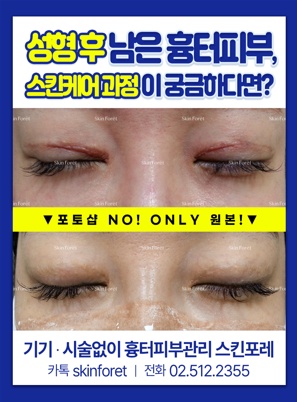 눈 재수술 전 오래된 흉터 케어, 스킨포레