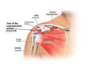 어깨가 아파요
