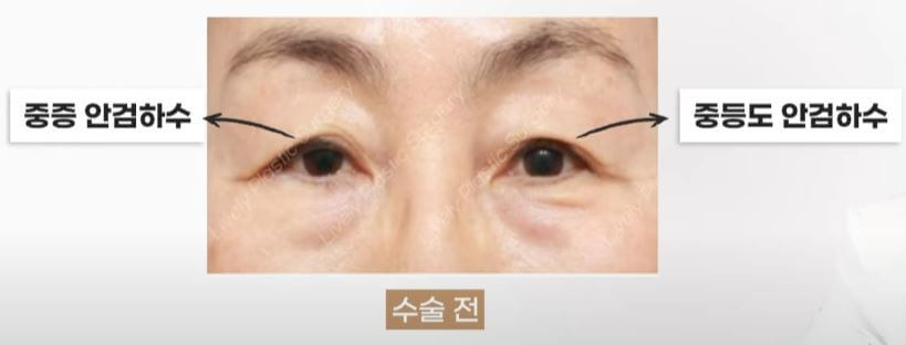 중증, 중등도 안검하수를 가진 사람 예시