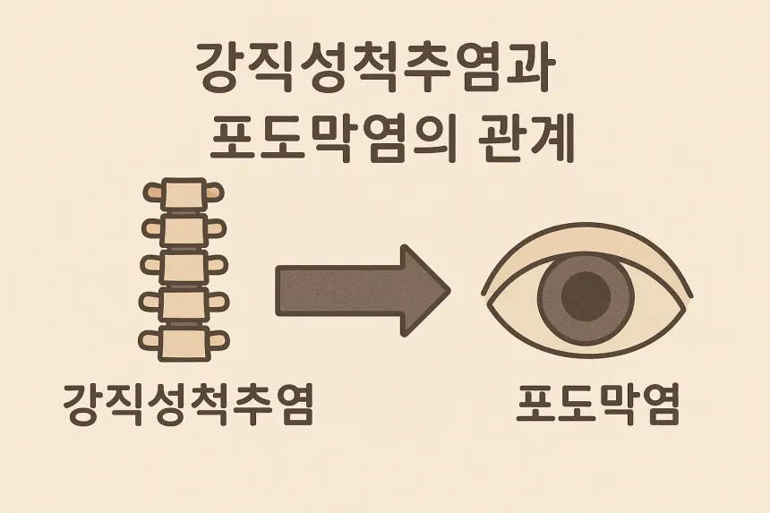 포도막염 강직성축추염