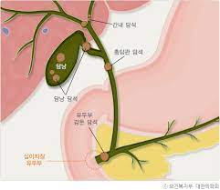 쓸개(담낭) 제거수술
