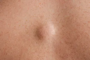 겨드랑이-멍울