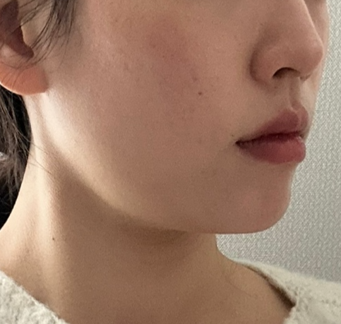 여드름피부 이중턱 제거 시술