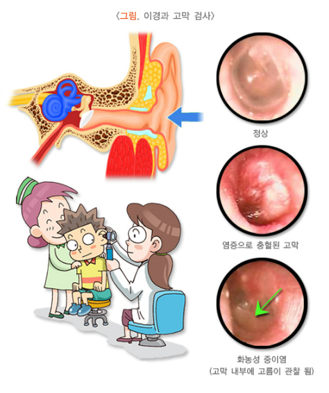 삼출성 중이염 중이염 빨리 낫는 법 아기 중이염 유아 중이염 자연치유