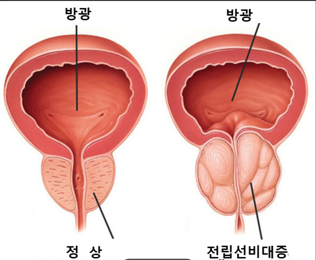 전립선 비대증 비교