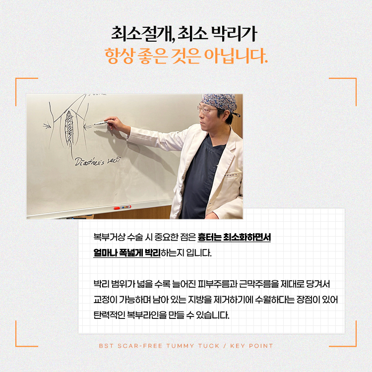 복부거상 수술 시 중요한 점은 흉터는 최소화하면서 얼마나 폭넓게 박리하는지입니다.
박리 범위가 넓을수록 늘어진 피부주름과 근막주름을 제대로 당겨서 교정이 가능하며 남아 있는 지방을 제거하기에 수월하다는 장점이 있어 탄력적인 복부 라인을 만들 수 있습니다.