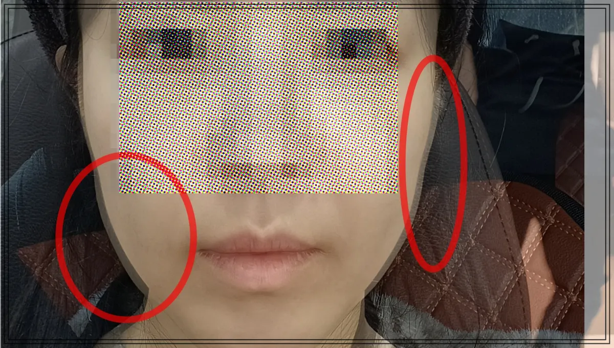 써마지-일주일-후-얼굴크기-변화