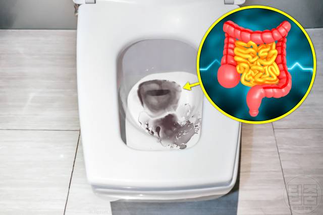 배가 찌르듯이 아픔 게실염 증상 혈변 장출혈