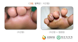 남자 사타구니 습진