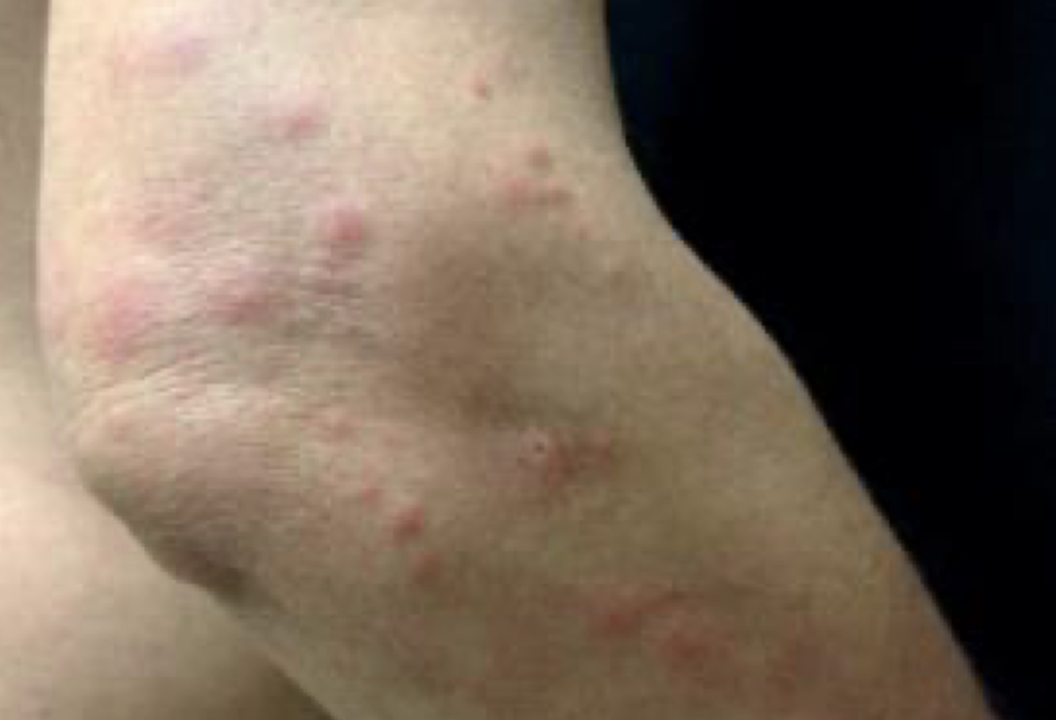빈대 물린자국