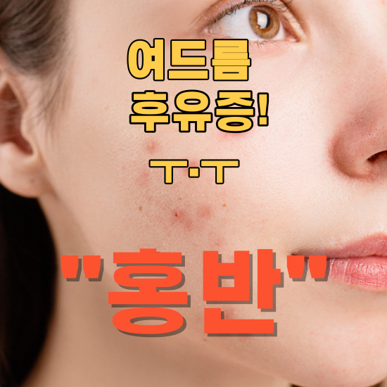 여드름 후유증으로 남은 홍반, 효과적인 관리법은?