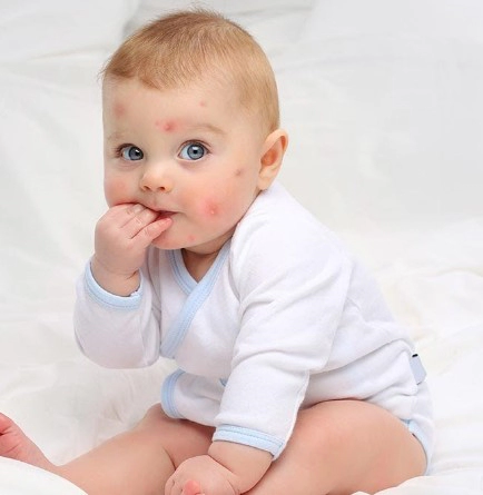 신생아 뾰루지 치료 및 예방