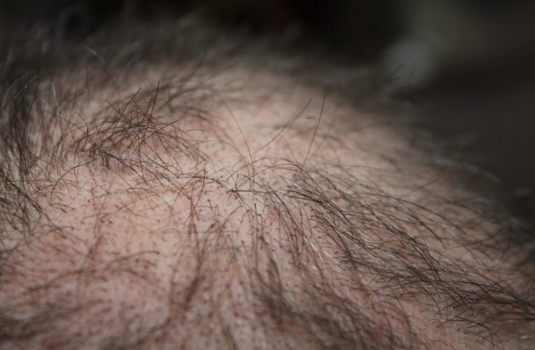 탈모 관련 사진