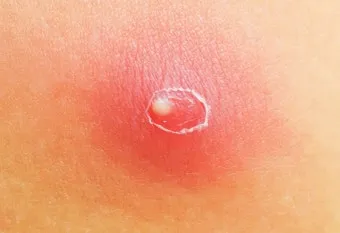 엉덩이 종기가 생기는 이유 왜 생기고 어떻게 관리할까요 완벽 가이드_17