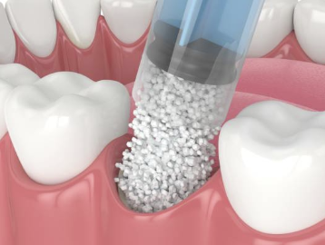 치아 뼈이식