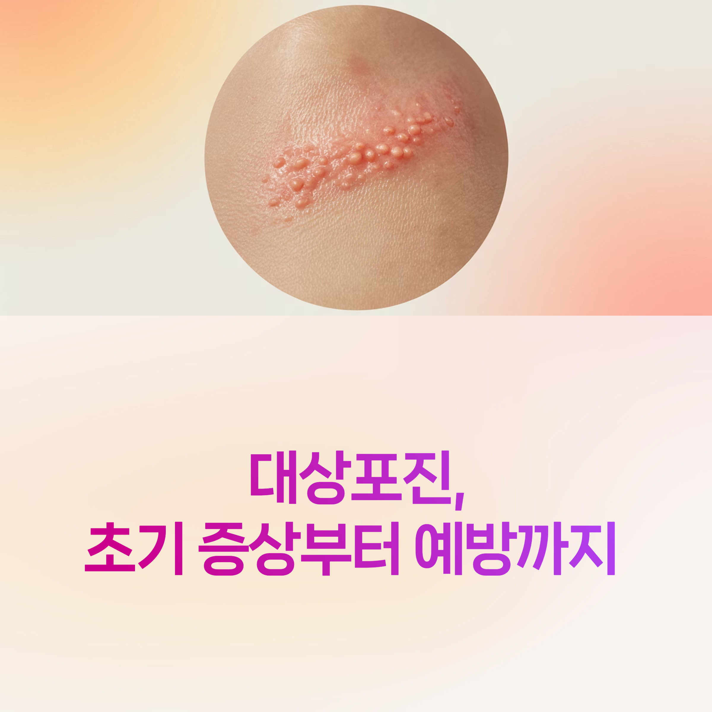 대상포진 예방접종,