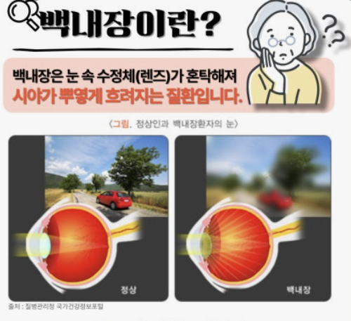 백내장 원인과 치료방법