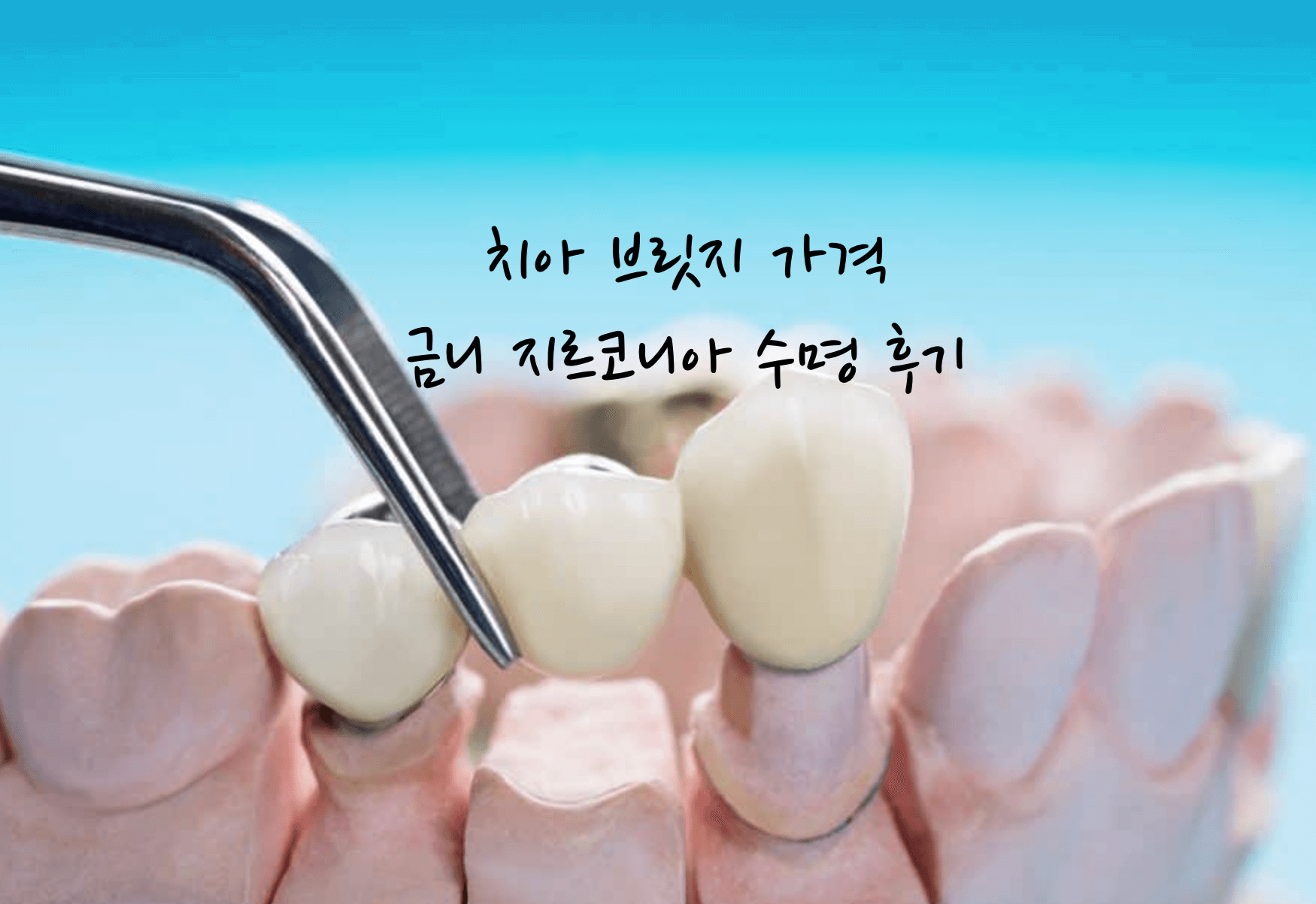 치아 브릿지 가격