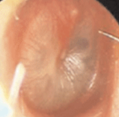 중이염 증상 10가지 총정리 섬네일