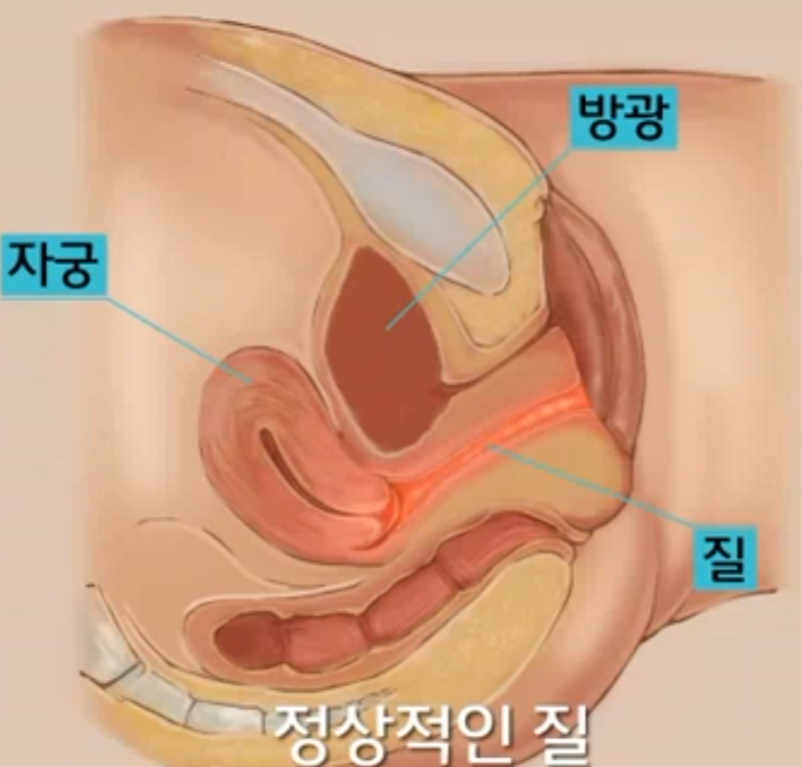 질이완증 / 질 이완 증상, 노화일까? / 질이완증 체크리스트 / 방치하면 생기는 문제와 해결 방법