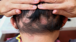 부분 원형 탈모