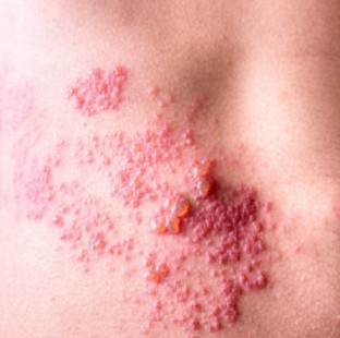 2024년 - 경기도 부천시 대상포진