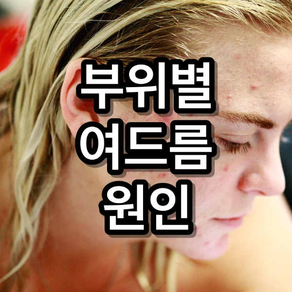 여드름 부위별 원인 이마, 턱, 코,미간, 목 관리하는 방법은