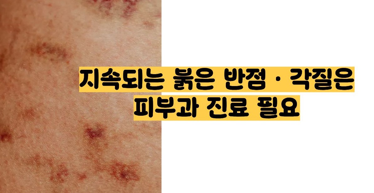 건선 초기증상