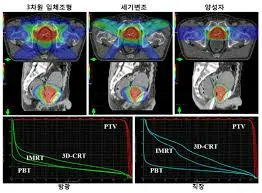 전립선암 초기증상