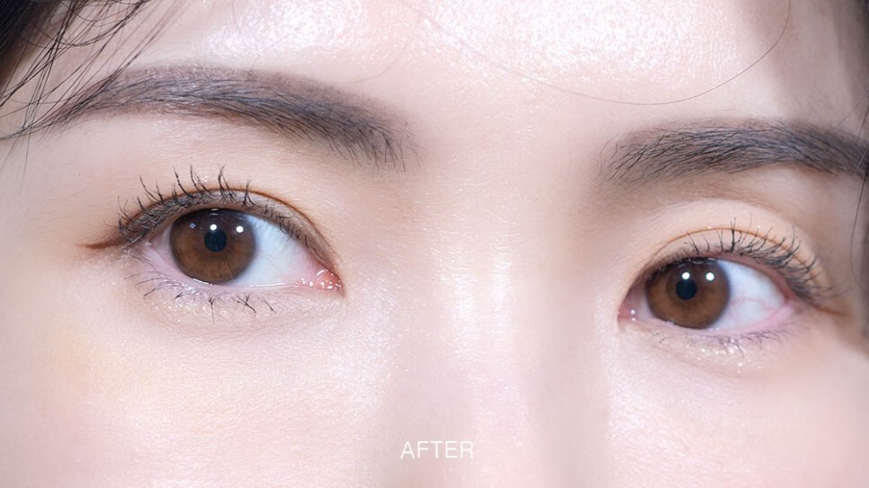 눈밑지방재배치 후기