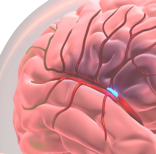 뇌경색 전조증상