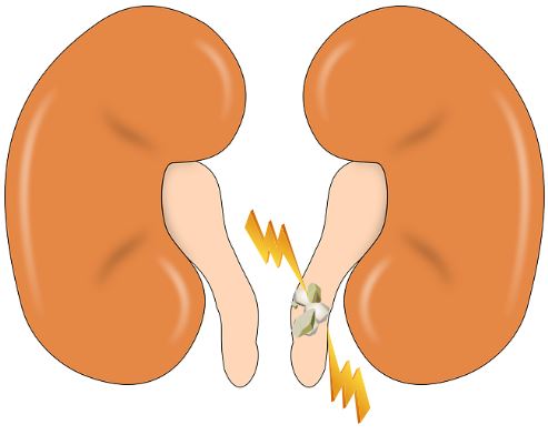 레몬물-효능-신장결석 예방 및 억제