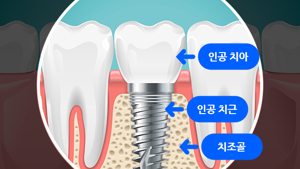 서울 임플란트