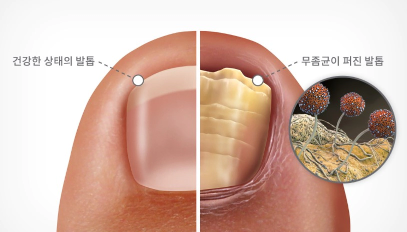무좀 습진 구별 방법 및 무좀 피부과 비용 정리