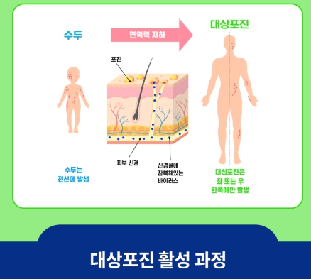 대상포진 초기 증상 후유증
