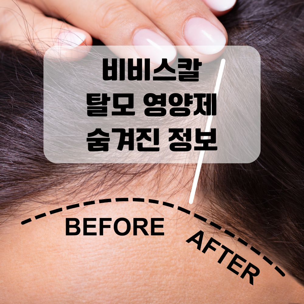 비비스칼_탈모영양제_썸네일