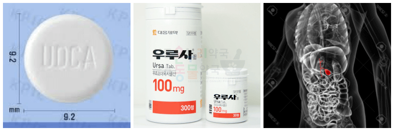 우루사정, 담낭 사진