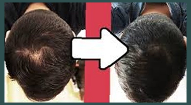 커클랜드 미녹시딜 직구