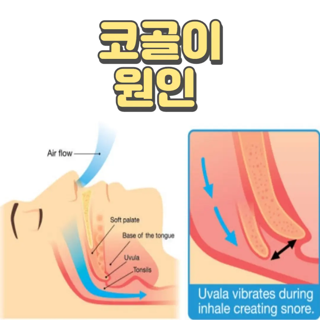 코골이원인