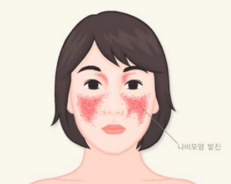 루푸스병 이란
