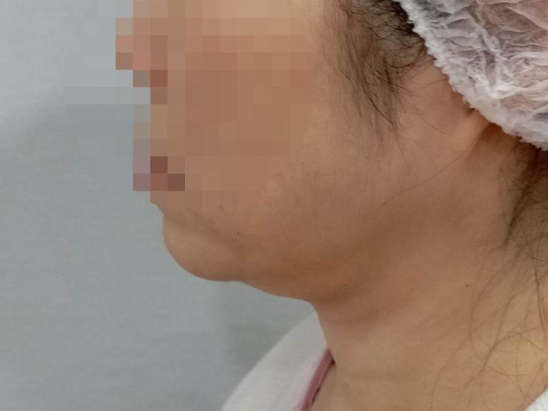  얼굴지방흡입 얼굴지방이식 안면윤곽수술 얼굴필러 얼굴보형물 얼굴성형 부작용 효과 붓기 멍 이중턱지방흡입