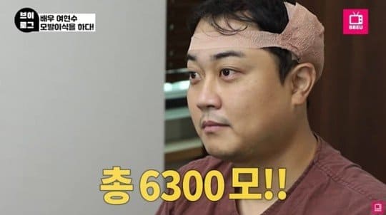 정수리 모발이식 비용부터 부위별 장단점까지 탈모 유형별 맞춤 전략