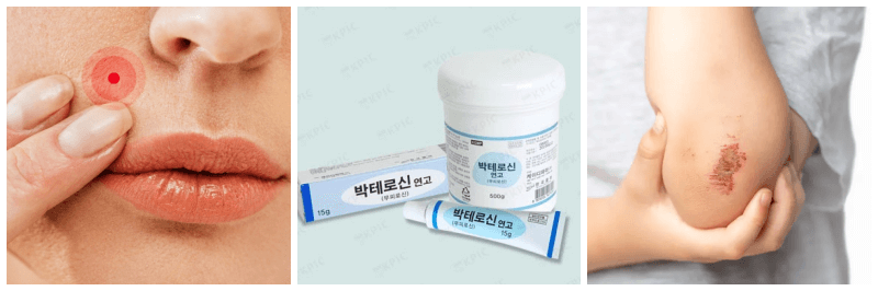 여드름, 박테로신 연고, 상처 사진