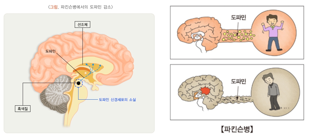 파킨슨병 원인